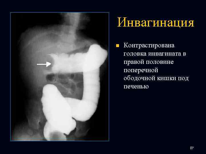 Инвагинация n Контрастирована головка инвагината в правой половине поперечной ободочной кишки под печенью 87
