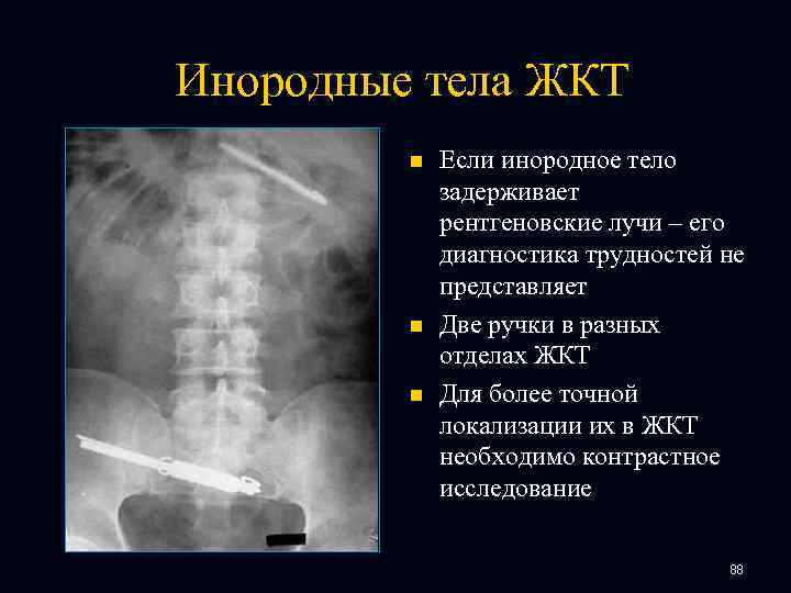 Инородные тела ЖКТ n n n Если инородное тело задерживает рентгеновские лучи – его