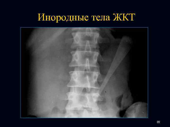 Инородные тела ЖКТ 89 