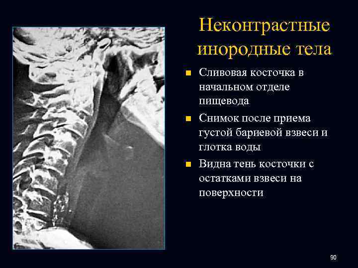 Неконтрастные инородные тела n n n Сливовая косточка в начальном отделе пищевода Снимок после