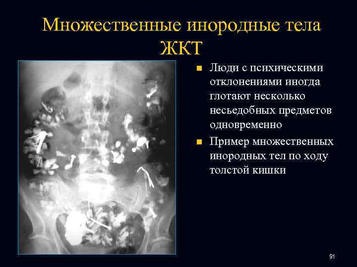 Множественные инородные тела ЖКТ n n Люди с психическими отклонениями иногда глотают несколько несьедобных