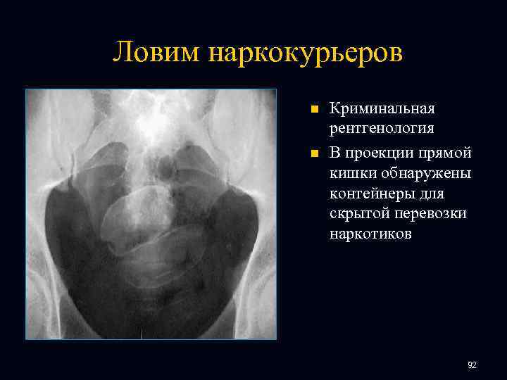 Ловим наркокурьеров n n Криминальная рентгенология В проекции прямой кишки обнаружены контейнеры для скрытой