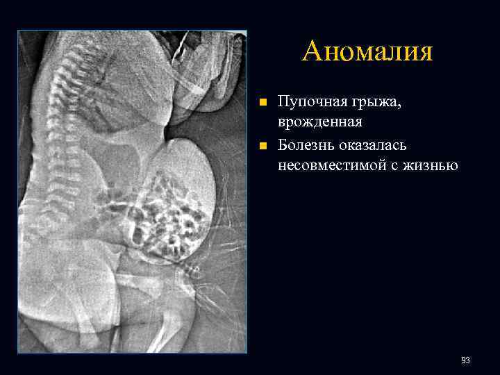 Аномалия n n Пупочная грыжа, врожденная Болезнь оказалась несовместимой с жизнью 93 