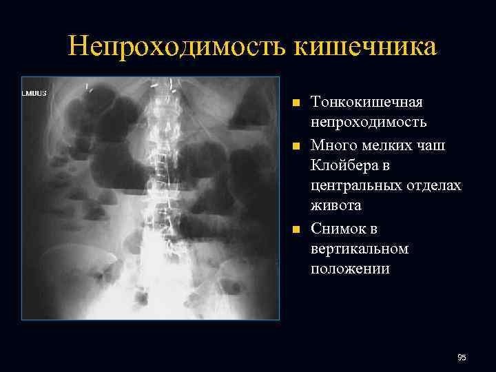 Непроходимость кишечника n n n Тонкокишечная непроходимость Много мелких чаш Клойбера в центральных отделах