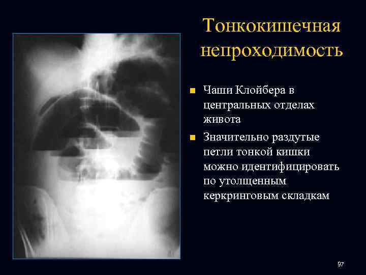Тонкокишечная непроходимость n n Чаши Клойбера в центральных отделах живота Значительно раздутые петли тонкой