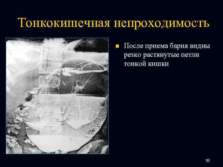 Тонкокишечная непроходимость n После приема бария видны резко растянутые петли тонкой кишки 98 