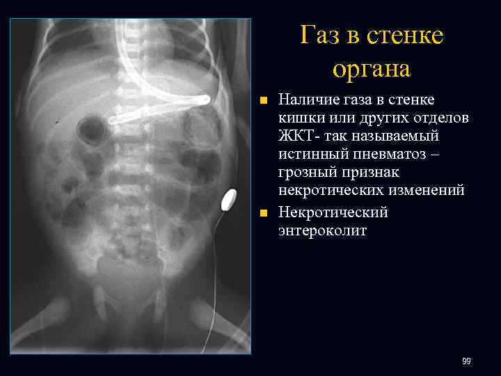 Газ в стенке органа n n Наличие газа в стенке кишки или других отделов