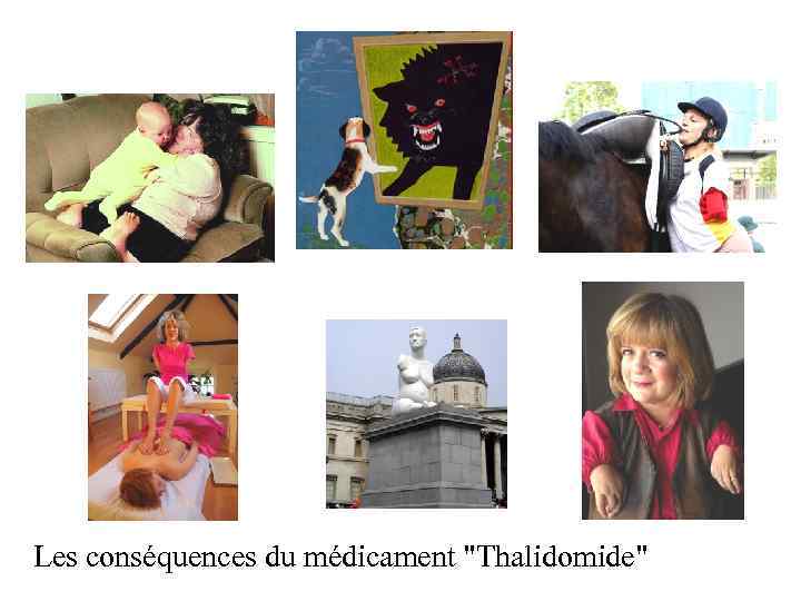 Les conséquences du médicament "Thalidomide" 