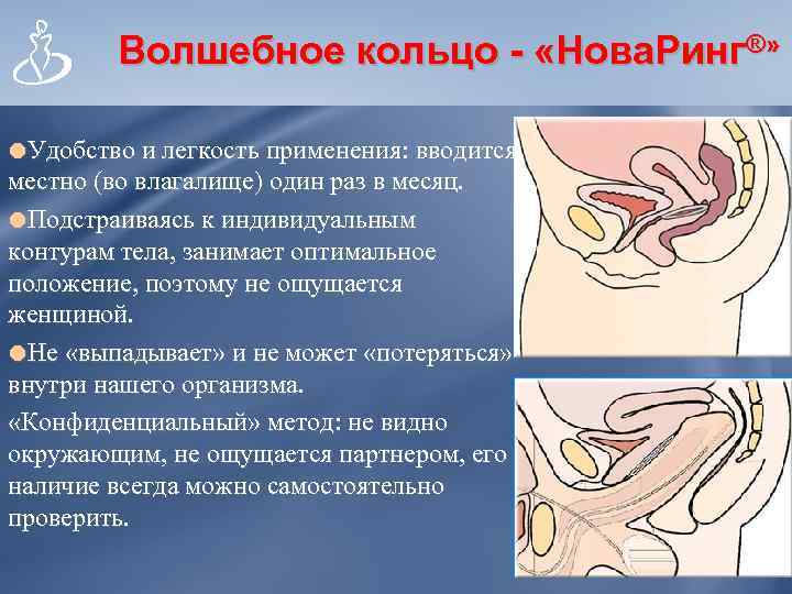 Волшебное кольцо - «Нова. Ринг®» Удобство и легкость применения: вводится местно (во влагалище) один