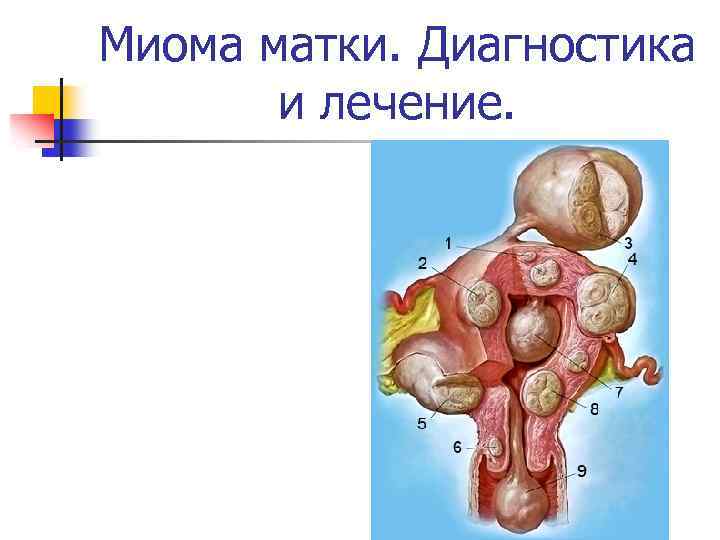 Миома матки. Диагностика и лечение. 