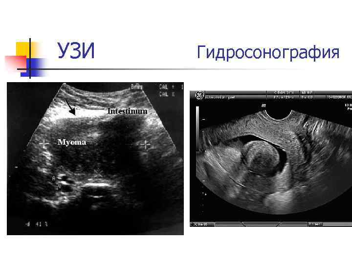 УЗИ Гидросонография 