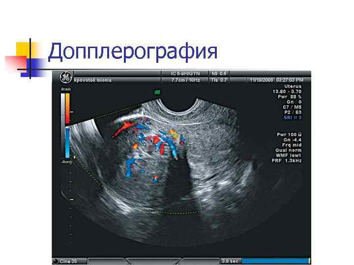 Допплерография 