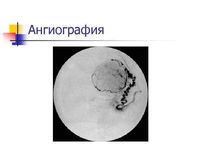 Ангиография 