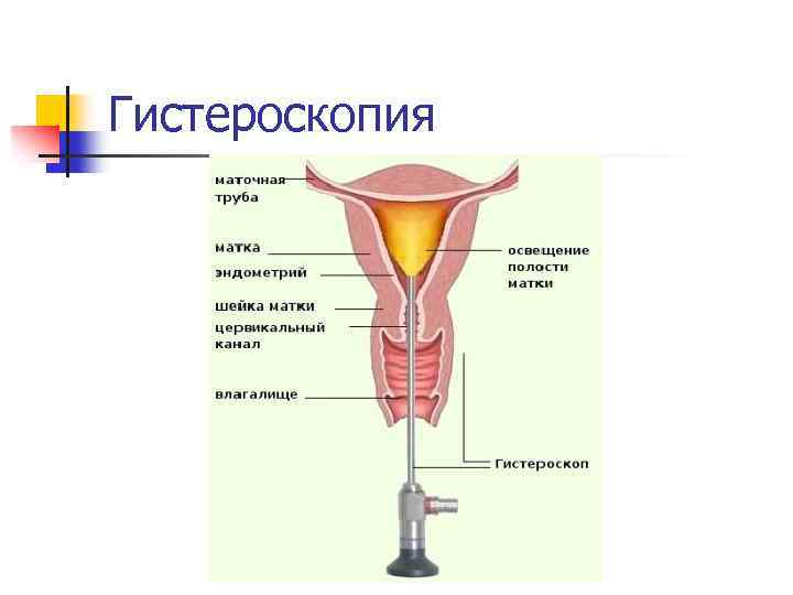 Гистероскопия 
