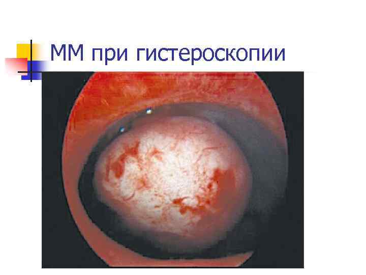 ММ при гистероскопии 