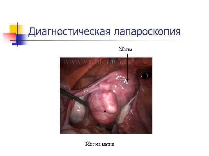Диагностическая лапароскопия 