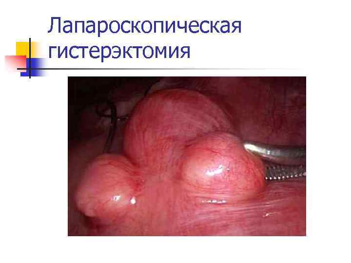Лапароскопическая гистерэктомия 