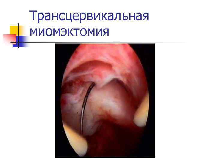 Трансцервикальная миомэктомия 