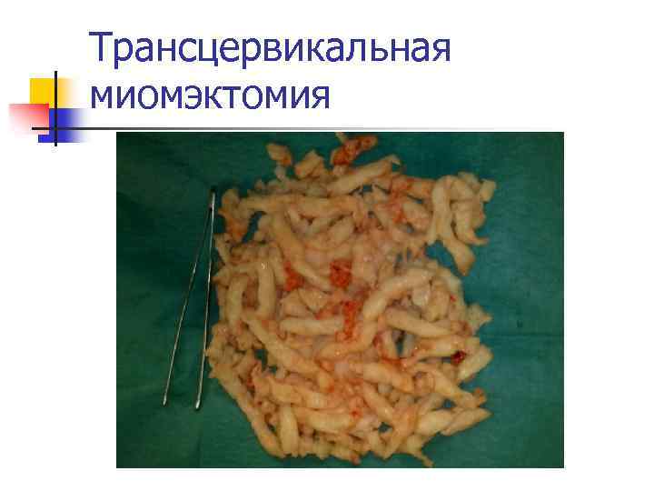 Трансцервикальная миомэктомия 