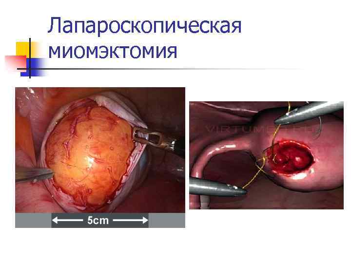 Лапароскопическая миомэктомия 