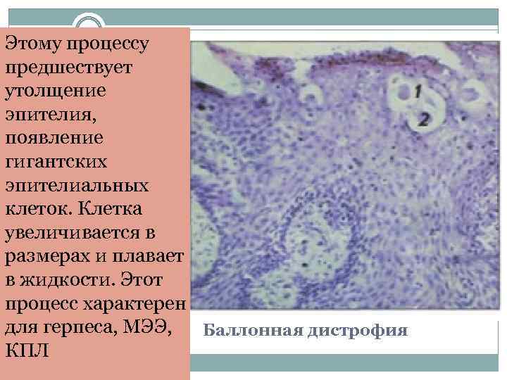 Картина крови при многоформной экссудативной эритеме тяжелой формы