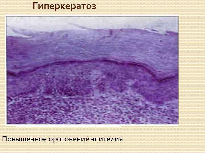 Гиперкератоз Повышенное ороговение эпителия 