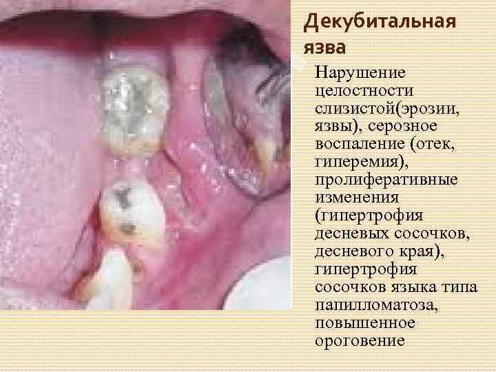 Воспаление слизистой рта фото