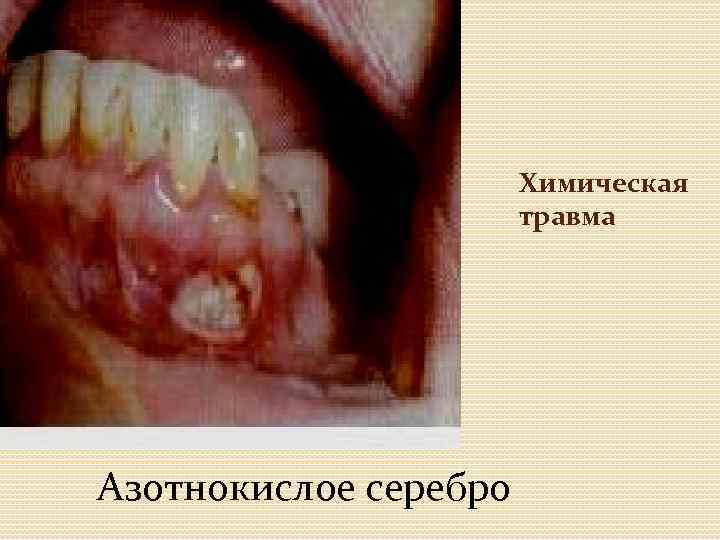 Химическая травма Азотнокислое серебро 