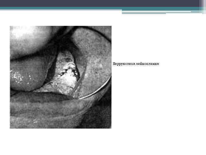 Веррукозная лейкоплакия 