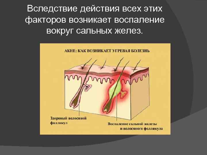 Вследствие действия всех этих факторов возникает воспаление вокруг сальных желез. 