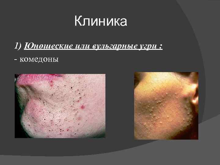 Клиника 1) Юношеские или вульгарные угри : - комедоны 