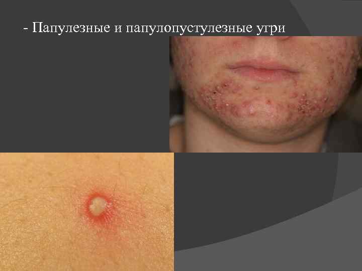 - Папулезные и папулопустулезные угри 