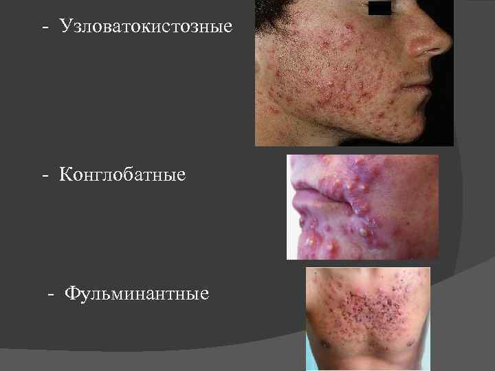  - Узловатокистозные - Конглобатные - Фульминантные 