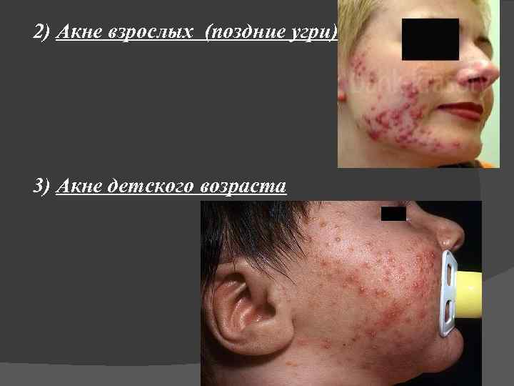 2) Акне взрослых (поздние угри) 3) Акне детского возраста 