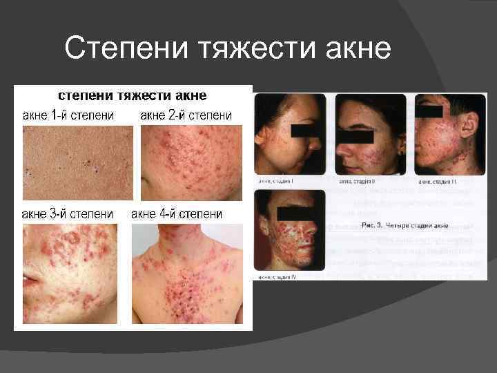 Степени тяжести акне 