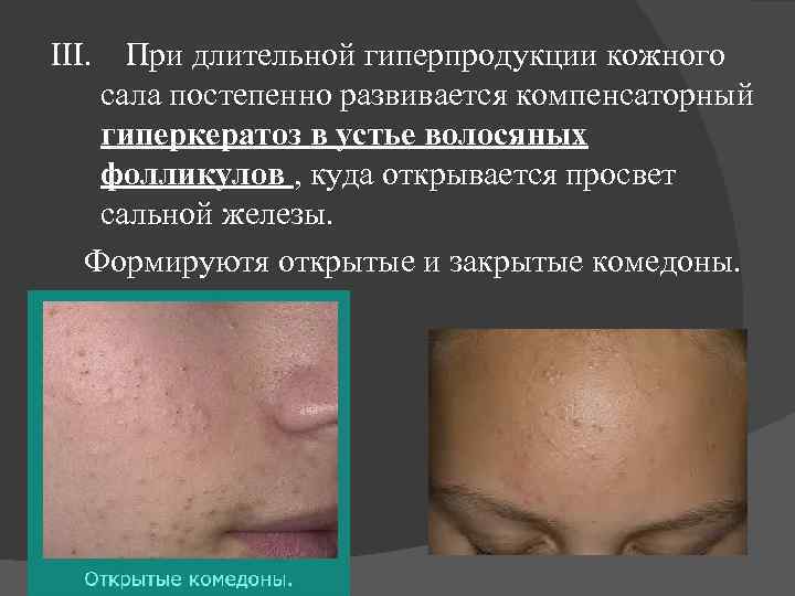 III. При длительной гиперпродукции кожного сала постепенно развивается компенсаторный гиперкератоз в устье волосяных фолликулов