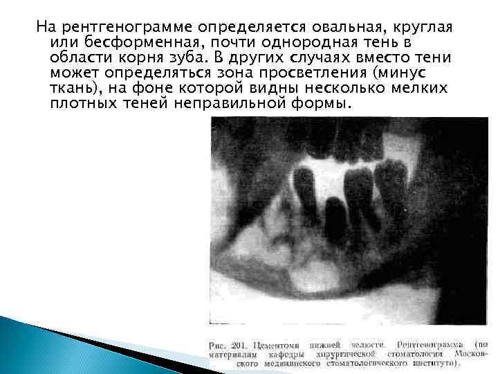 На рентгенограмме определяется овальная, круглая или бесформенная, почти однородная тень в области корня зуба.