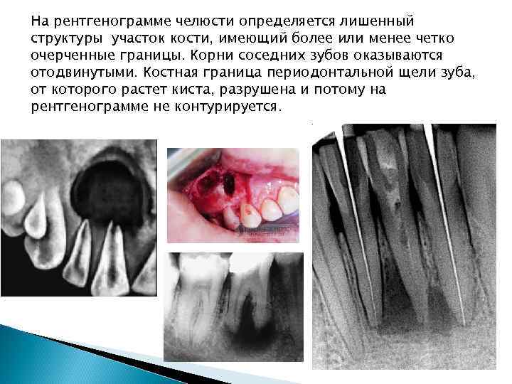 На рентгенограмме челюсти определяется лишенный структуры участок кости, имеющий более или менее четко очерченные