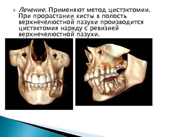  Лечение. Применяют метод цистэктомии. При прорастании кисты в полость верхнечелюстной пазухи производится цистэктомия