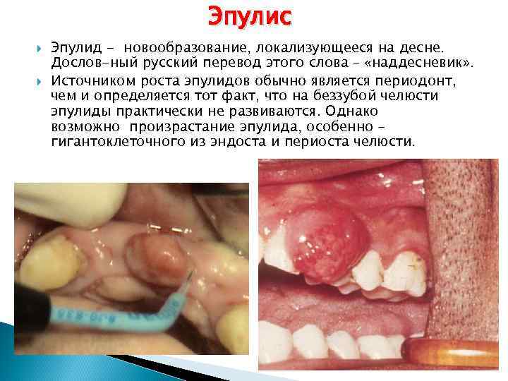 Эпулис Эпулид - новообразование, локализующееся на десне. Дослов-ный русский перевод этого слова – «наддесневик»