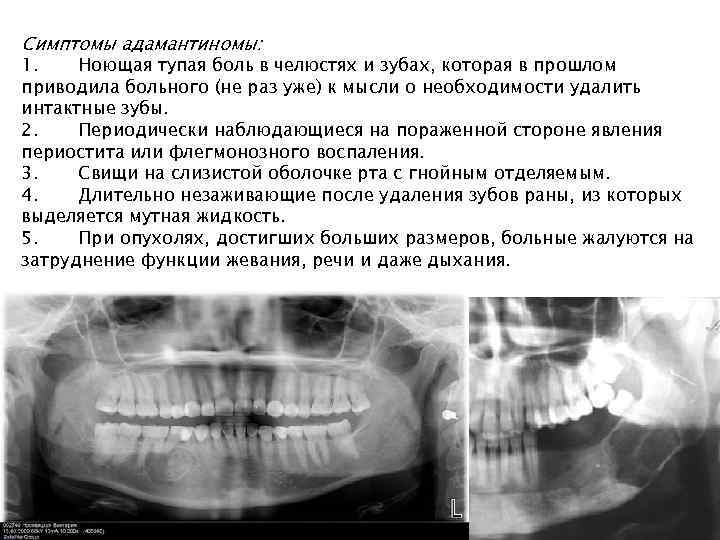 Симптомы адамантиномы: 1. Ноющая тупая боль в челюстях и зубах, которая в прошлом приводила