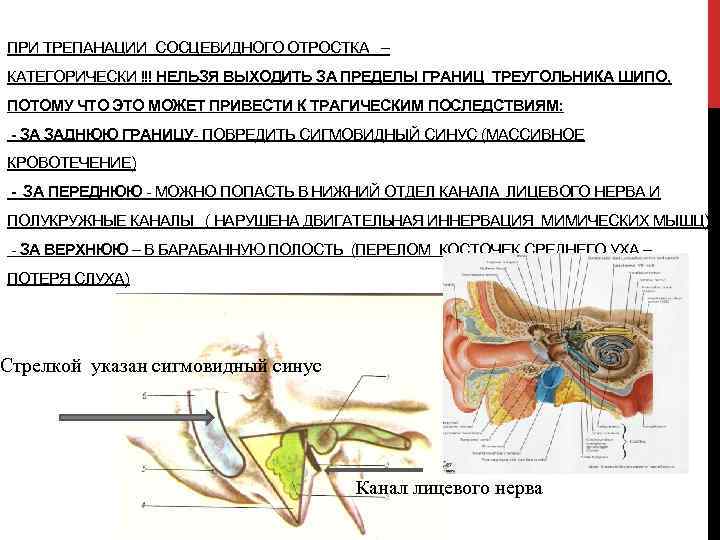 ПРИ ТРЕПАНАЦИИ СОСЦЕВИДНОГО ОТРОСТКА – КАТЕГОРИЧЕСКИ !!! НЕЛЬЗЯ ВЫХОДИТЬ ЗА ПРЕДЕЛЫ ГРАНИЦ ТРЕУГОЛЬНИКА ШИПО,