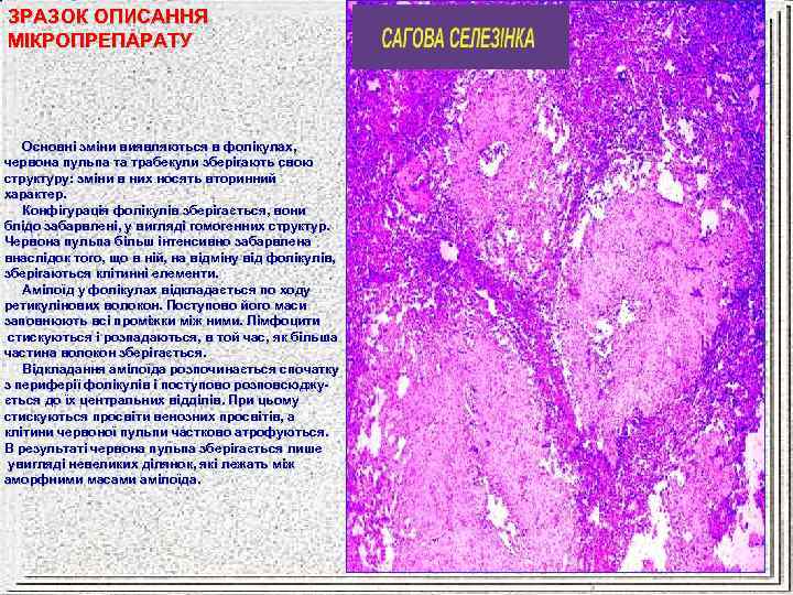 ЗРАЗОК ОПИСАННЯ МІКРОПРЕПАРАТУ Основні зміни виявляються в фолікулах, червона пульпа та трабекули зберігають свою