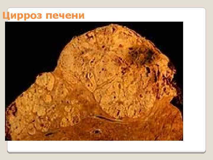 Цирроз печени, приведший к гепатоцеллюлярной карциноме (макропрепарат) 