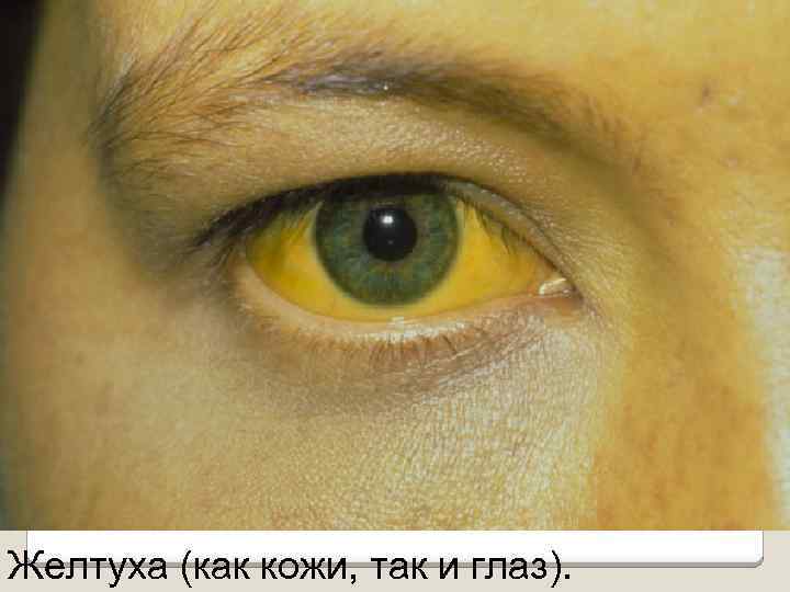 Желтуха (как кожи, так и глаз). 