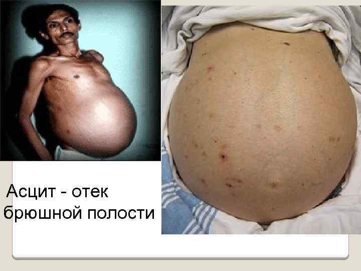 Асцит отек брюшной полости 