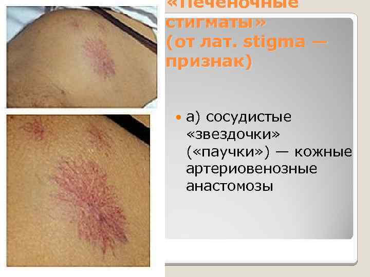  «Печеночные стигматы» (от лат. stigma — признак) а) сосудистые «звездочки» ( «паучки» )