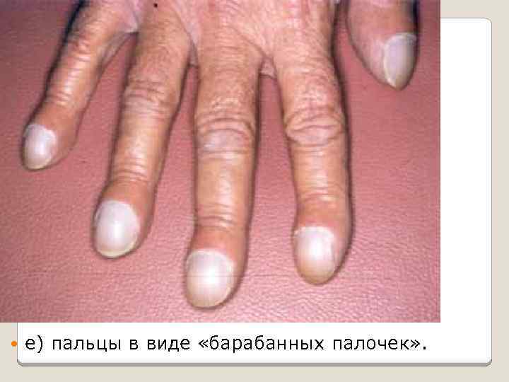  е) пальцы в виде «барабанных палочек» . 