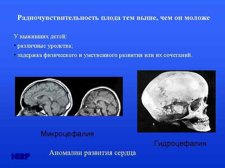 Радиочувствительность плода тем выше, чем он моложе У выживших детей: • различные уродства; •