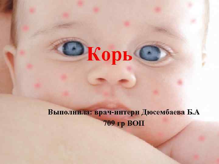 Корь Выполнила: врач-интерн Дюсембаева Б. А 709 гр ВОП 